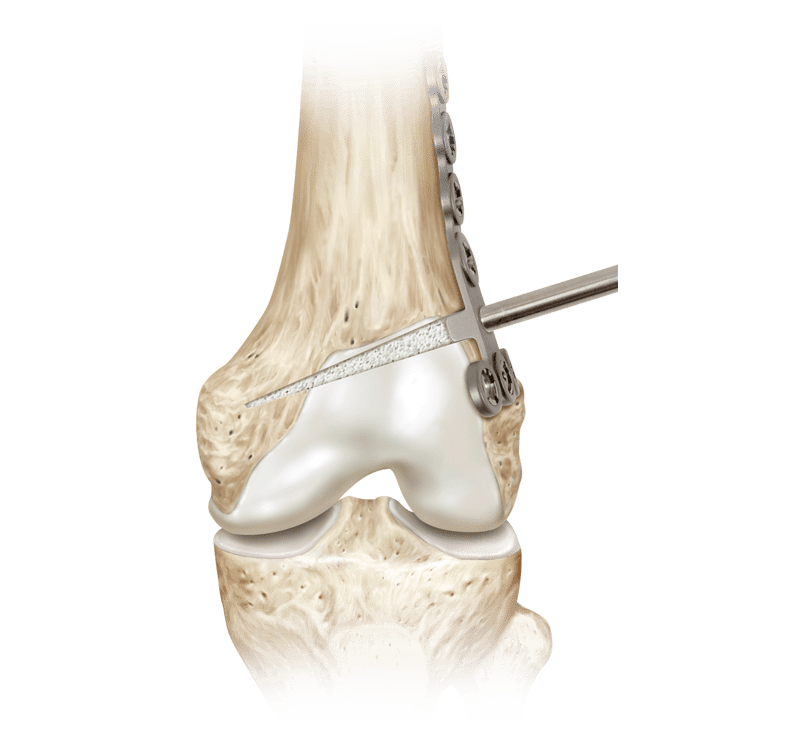 Arthrex - Distal Femoral Osteotomy